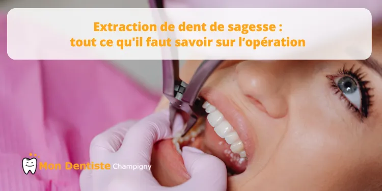 Extraction de dent de sagesse : tout ce qu’il faut savoir avant, pendant et après l’opération